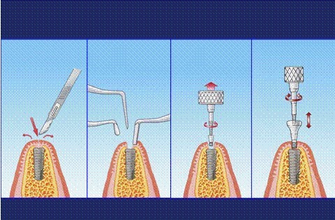 ankylos种植牙流程示意图