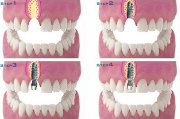 种植牙过程