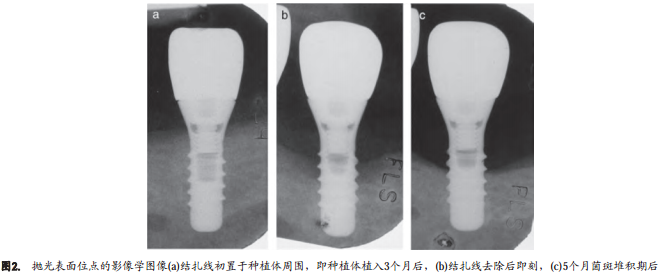 不同表面粗糙度种植体周围结扎棉线诱导种植体周围炎的自然发展过程