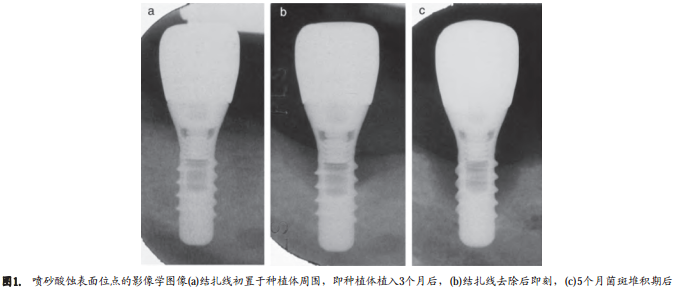 不同表面粗糙度种植体周围结扎棉线诱导种植体周围炎的自然发展过程