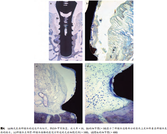 不同表面粗糙度种植体周围结扎棉线诱导种植体周围炎的自然发展过程
