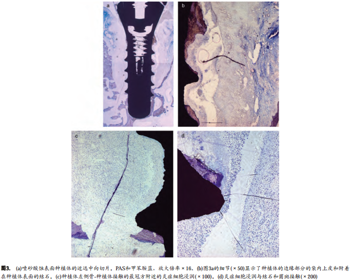 不同表面粗糙度种植体周围结扎棉线诱导种植体周围炎的自然发展过程