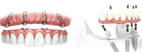 All-on-4全口种植牙齿