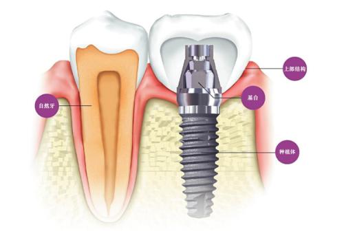 种植牙和真牙的区别